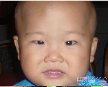 成人斜视恢复方法视频,跟随视频学习成人斜视恢复方法