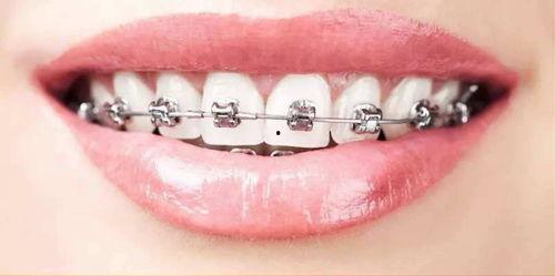 成人正畸怎么做视频,轻松掌握矫正牙齿的步骤与技巧